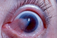 pterygium.jpg