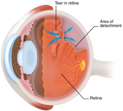 retinal_detachment_drawing.jpg