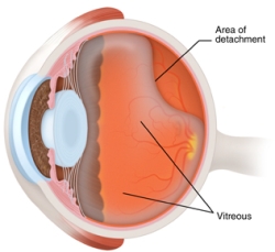 vitreous_detachment_drawing.jpg